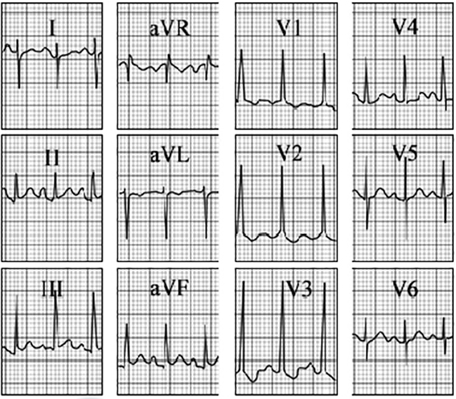 ECG answer 3