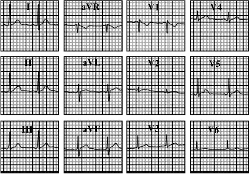 ECG answer 3