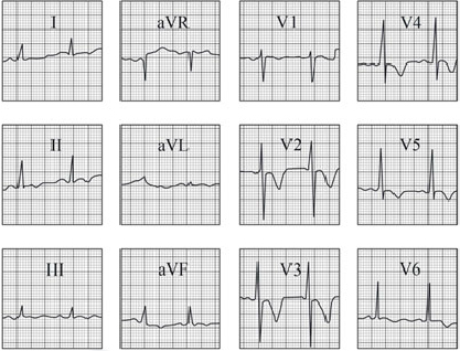 ECG answer 3