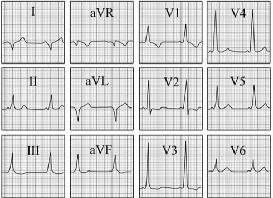 ECG answer 3