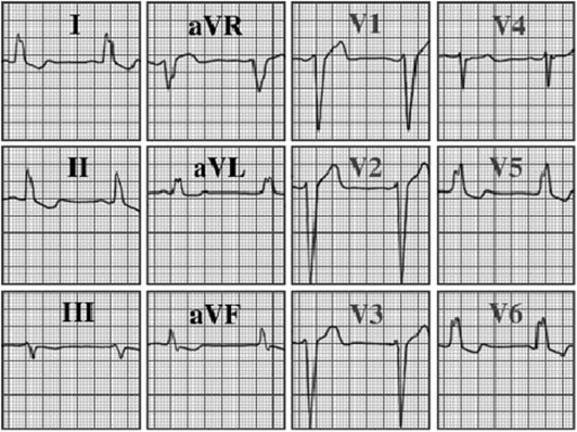 ecg