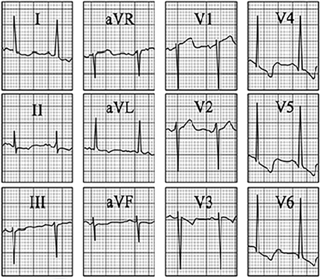 ECG answer 3