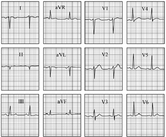 ECG answer 3