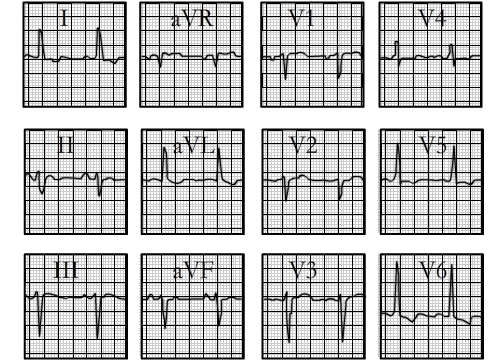 ecg