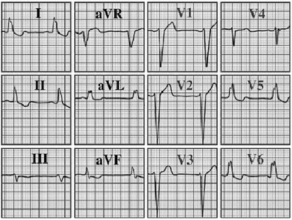 ECG answer 3