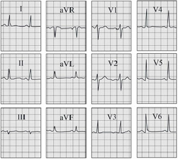 ECG answer 3