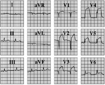 ECG answer 3