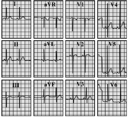 ecg