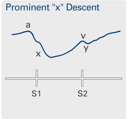 Prominent Descent