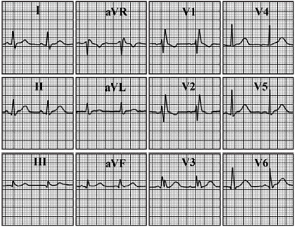 ECG answer 3