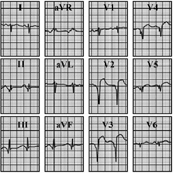 ECG answer 3